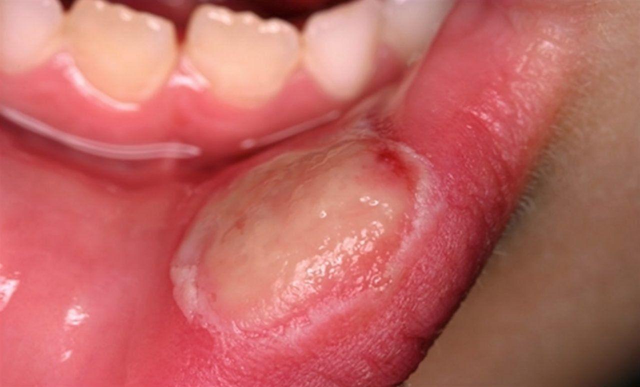 Máu trong miệng kèm đau đớn